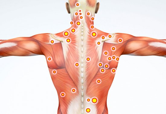 Dry Needling